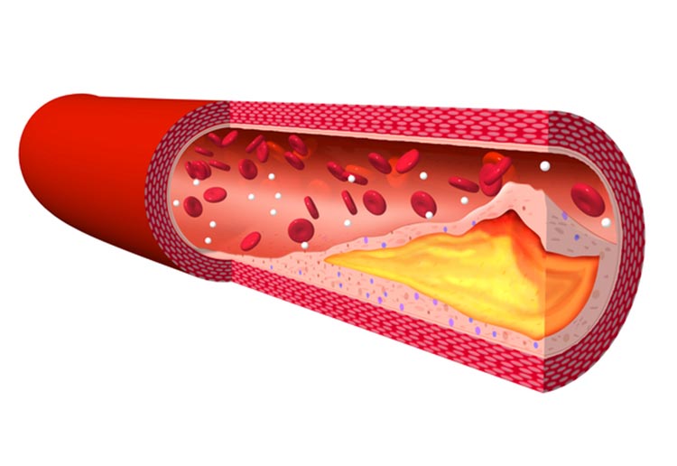 動脈硬化による狭窄