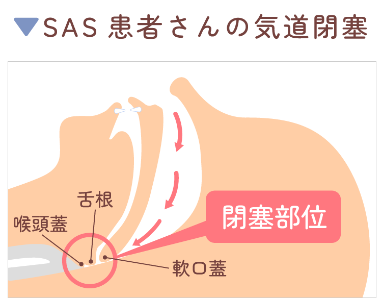 SAS患者さんの気道閉塞